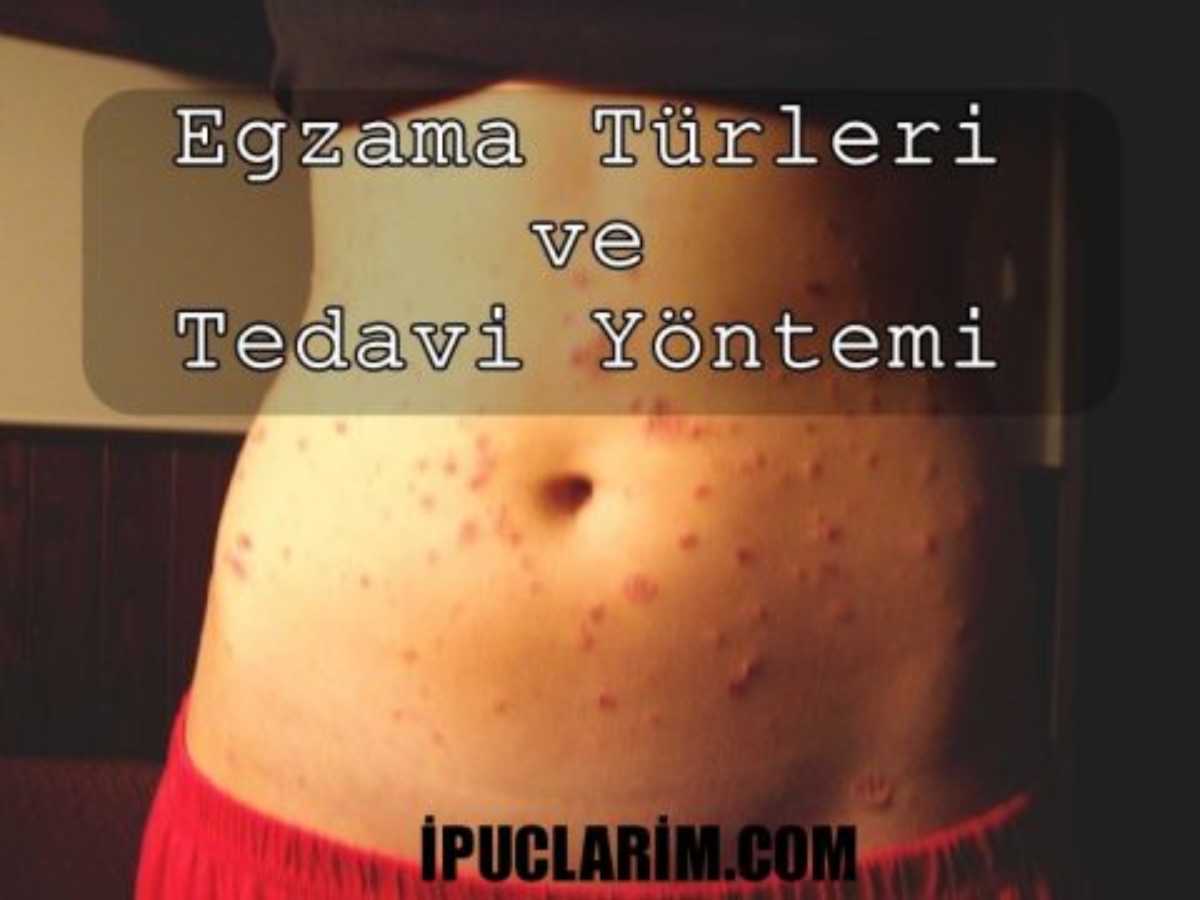 Egzama Turleri Ve Tedavi Yontemi Ipuclarim